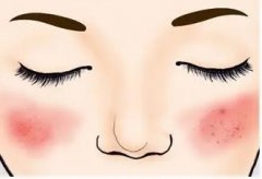 南京皮肤科研究院可以看脸上红血丝吗