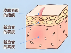 南京什么医院疤痕手术做得好